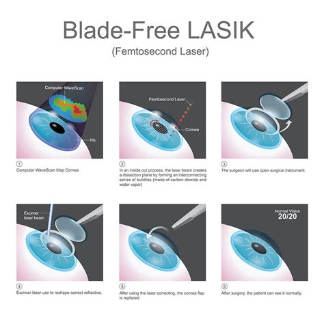 Lasik Eye Surgery Los Angeles Laser Vision Medical Associates