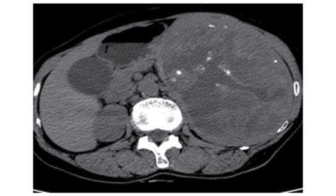 Follicular Dendritic Cell Sarcoma Of The Spleen A Case Report And
