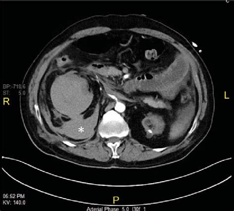 Abdominal Contrast Enhanced Computed Tomography Scan Showing