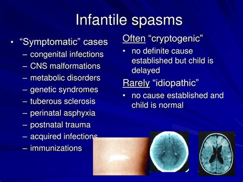 Ppt Pediatric Epilepsy An Overview And Update On Treatment Options