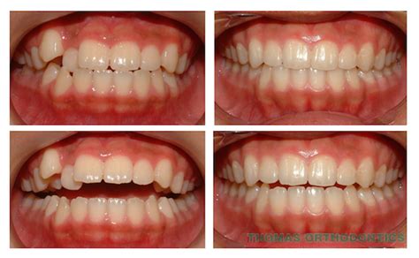 Small gaps can form in the front teeth. What to Expect Before and After Braces | Thomas Orthodontics