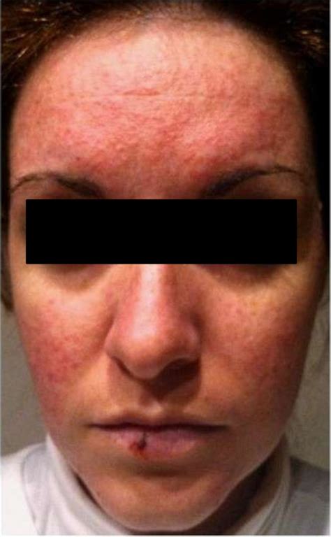 Rosacea Like Facial Rash Related To Metformin Administration In A Young