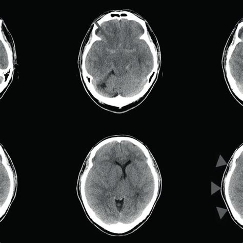 Initial Non Contrast Brain Computed Tomography Findings Showed
