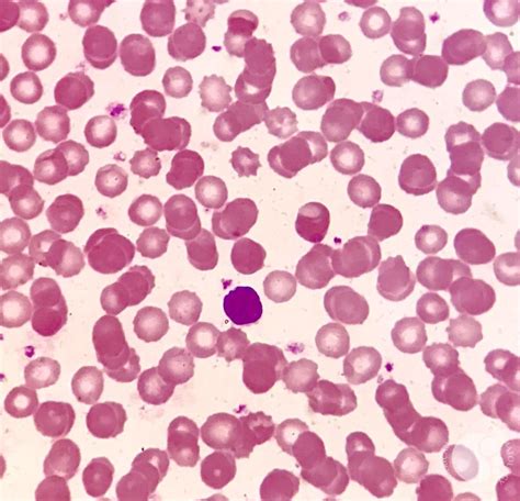 Peripheral Blood Film Shows Normal Rbc Density With Normocytic