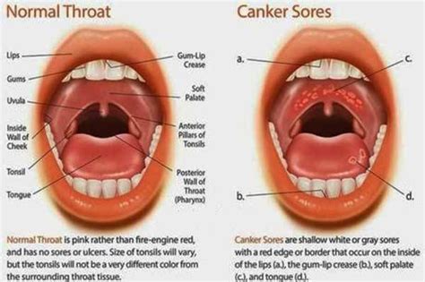Cold sores, canker sores, and chancres. Canker Sores and Mouth ulcers can be really painful and ...