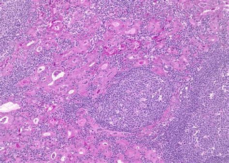 Prominent Oncocytic Change In Chronic Lymphocytic Thyroiditis Abundant