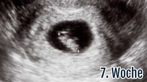Wann macht man einen schwangerschaftstest? Kein Embryo zu sehen, 7ssw, sondern nur längliche ...