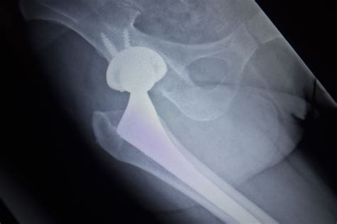 Stryker Accolade Hip Implant Patients May Face Risk Of Metal Poisoning