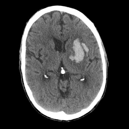 Hypertensive Cerebral Hemorrhage Sexiezpix Web Porn