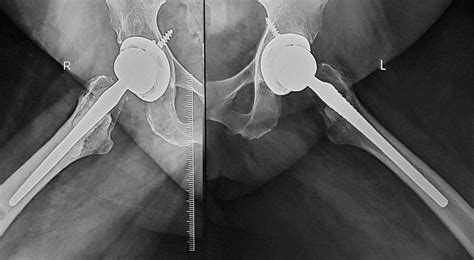 Cureus Bilateral Femoral Neck Stress Fracture In An Obese Middle Aged