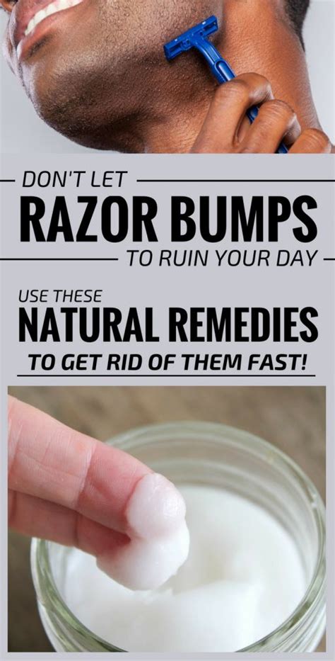 Pin By Beth Villines On General Razor Bumps Natural Remedies Razor Bumps Men