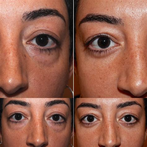 Cat Eye Surgery Before And After Cool Part Diary Stills Gallery