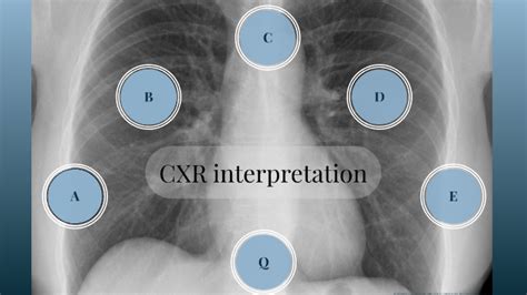 Cxr Interpretation By Scp Radiology