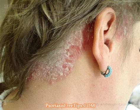 Scalp Psoriasis How To Identify The Symptoms