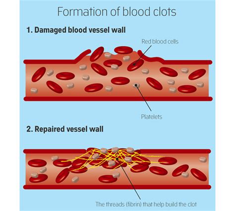 How Blood Clots Go From Good To Bad Cancerclot™