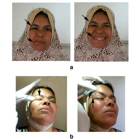 A Case Of Hemifacial Spasm Treated With Botox Injection A