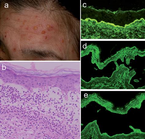 A Case Of Subepidermal Blistering Disease With Autoantibodies To