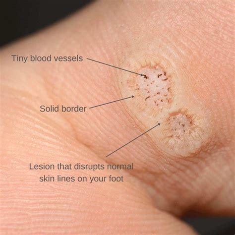 Plantar Warts Causes Symptoms Treatment The Feet People Podiatry