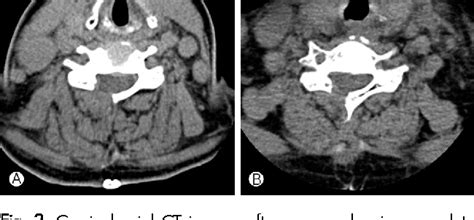 Figure 3 From Acute Spontaneous Cervical Epidural Hematoma Mimicking