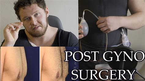 GYNECOMASTIA SURGERY Post Op REVIEW How It Went Recovery What To