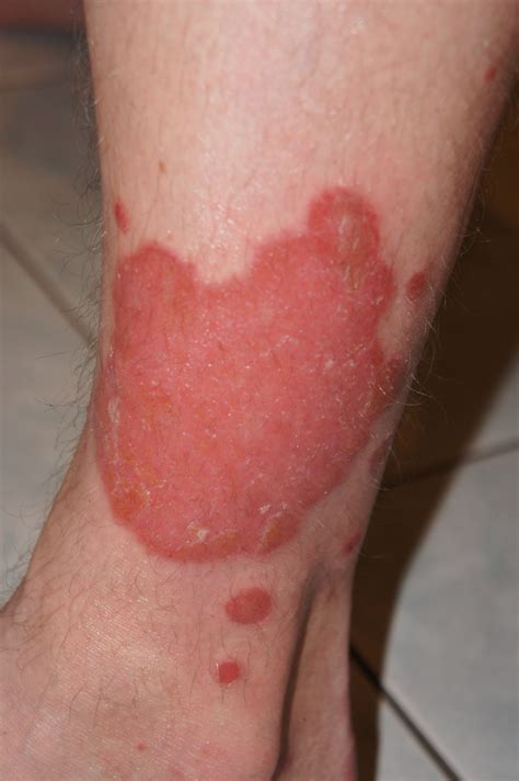 Treatment Options For Different Types Of Psoriasis The Dermatology Clinic
