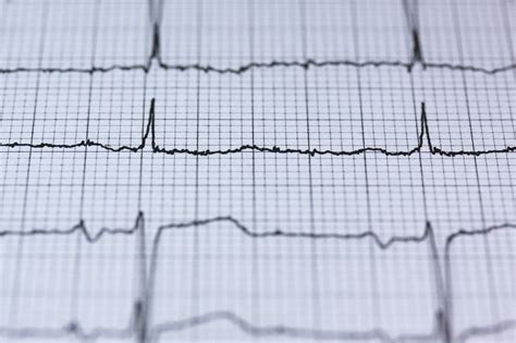 EKG Na Czym Polega To Badanie WK24 PL