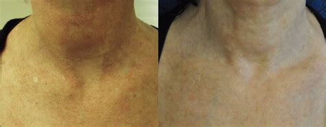 Laser Protocol Specialist Skin Clinic Nuriss