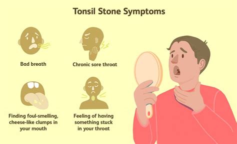 How To Tonsil Stones Removal Everything Explained Step By Step