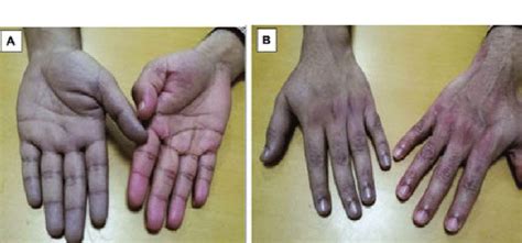 Peripheral Cyanosis Of Patients Hand At Diagnosis Compared To His