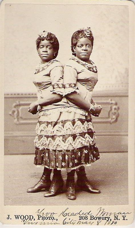 Siamese Sisters Human Oddities Vintage Circus Conjoined Twins