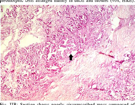 Figure Ii From Collecting Duct Carcinoma Of The Kidney Semantic Scholar