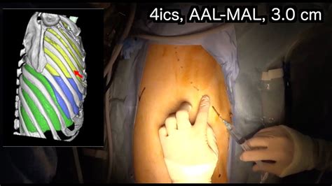 80】uniportal Vats Rul Right Upper Lobectomy With Lnd Youtube