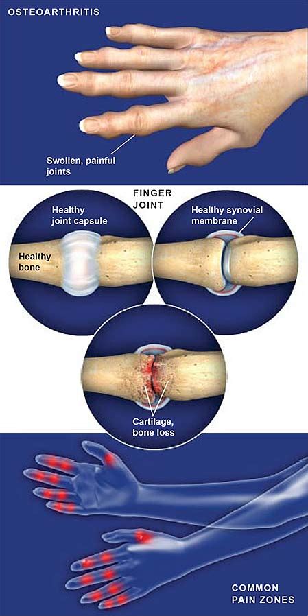 Osteoartritis De La Mano Grupo Médico Ortopédico De La Costa Central