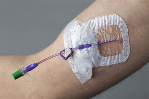 Picc Peripherally Inserted Central Catheter Stock Photo Image Of