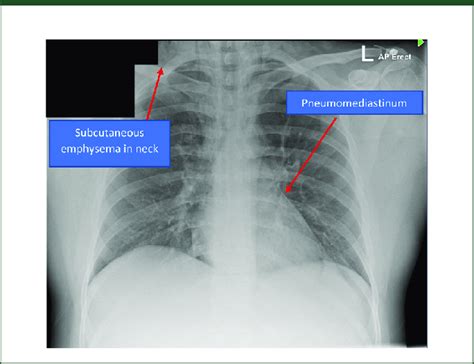 Chest Radiography Showing Pneumomediastinum And Subcu Vrogue Co