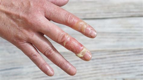 The 6 Most Common Finger Injuries And How To Avoid Them
