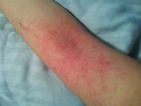 Rashes In Elbow Creases Pictures Photos