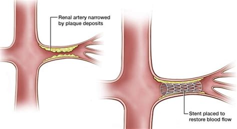 Renal Artery Stenting Center For Advanced Cardiac And Vascular