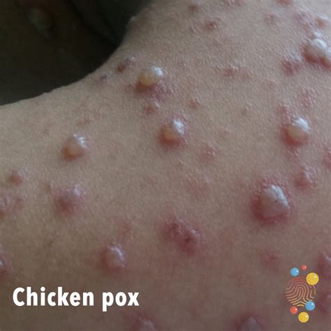 Chicken Pox Skin Deep