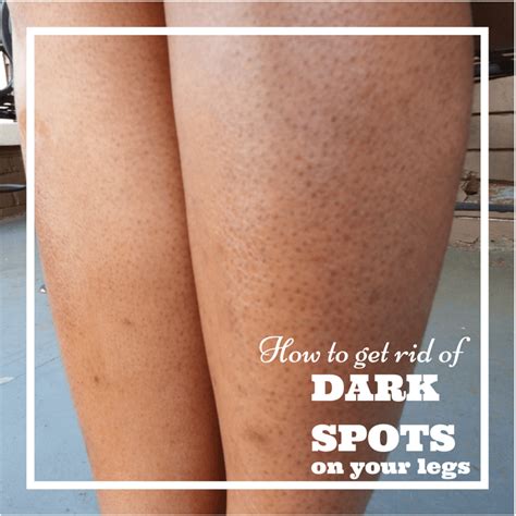 How To Get Rid Of Dark Spots On Legs Fast 13 Easy Ways Dark Pores