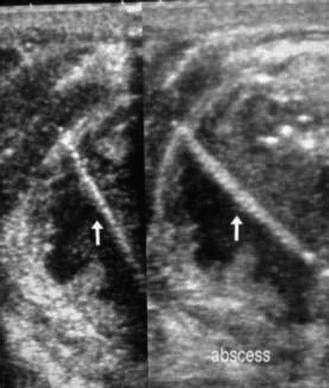 A Usg Scan Showing Neck With Neck Abscess Caused By A 2 Cm Tilapia Fish