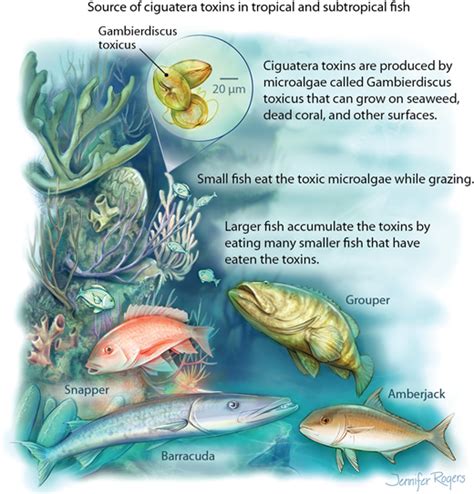 Ciguatera Fish Poisoning Emergency Medicine Jama Jama Network