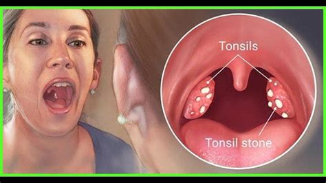 Remedies Of Tonsillitis With 50 Symptoms In Homoeopathy Youtube