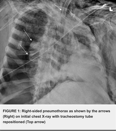 Massive Pneumomediastinum And Subcutaneous Emphysema Secondary To My