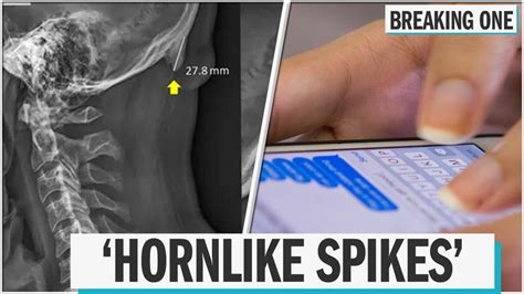 People Are Growing Horns On The Back Of Their Skulls Due To Phone Use