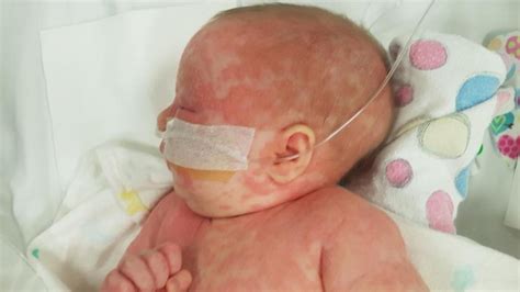 Brisbane Newborn Baby Awaits Bone Marrow Transplant While Suffering