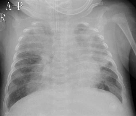 Chest Radiograph Showing Bilateral Diffuse Infiltration And Upper Lungs