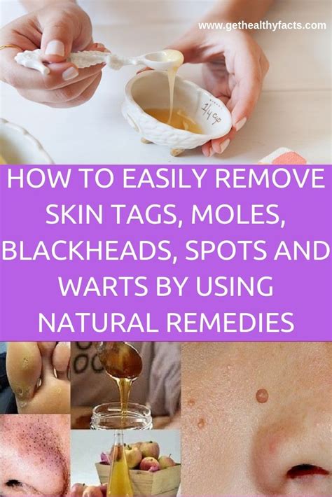 Remove Skin Tags On Eyelids Naturally Eglopers