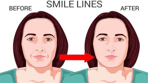 Home Remedies To Treat Smile Lines Remove Mouth Wrinkles At Home Youtube