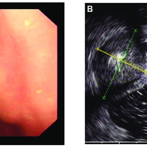 A Endoscopic View Of The Protruding Tumor In The Gastric Antrum B